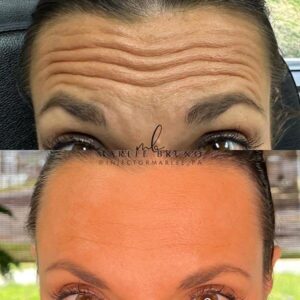 before and after forehead