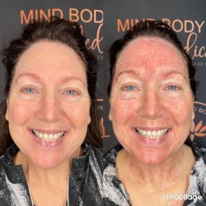 before and after microneedling