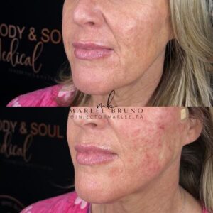 before and after red skin cheeks