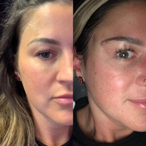 before and after smooth chin