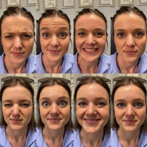 before and after wrinkles