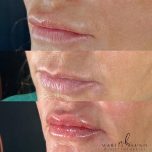 mind body and soul medical before and after lips