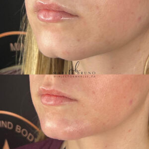 mind body and soul medical before and after lower face