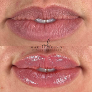 mind body and soul medical close up lip procedure