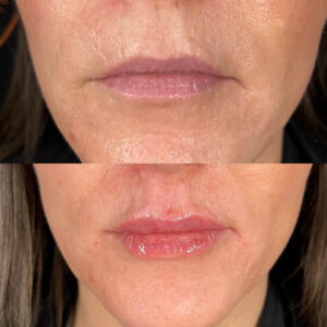 mind body and soul medical filler before and after comparison
