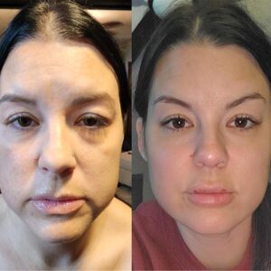 mind body and soul medical full facial before and after