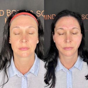 mind body and soul medical full facials front before and after