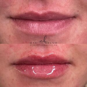 mind body and soul medical fuller lips comparison