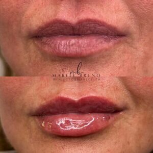 mind body and soul medical injectable fillers