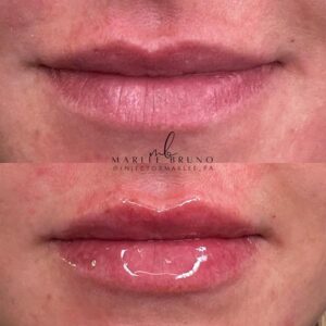 mind body and soul medical injectable lip filler