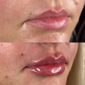 mind body and soul medical lip filler