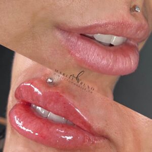 mind body and soul medical lip filler with piercing