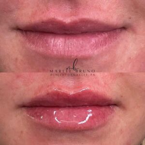 mind body and soul medical lip fillers