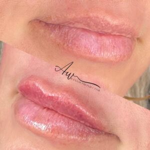 mind body and soul medical lip fillers