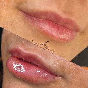 mind body and soul medical lip fillers