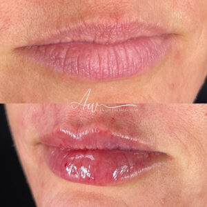 mind body and soul medical lip procedures