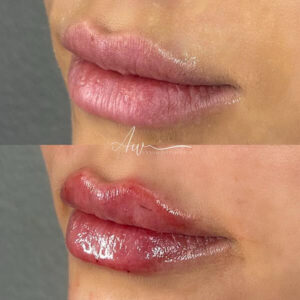 mind body and soul medical lips before and after
