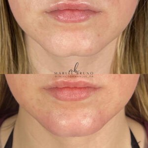 mind body and soul medical lower face before and after