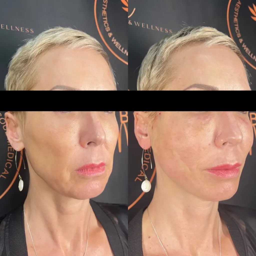mind body and soul medical full facial before and after