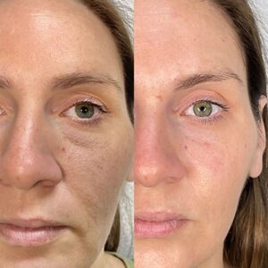 Face juviderm before and after 01