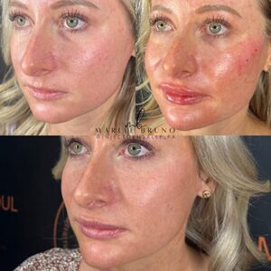 Face juviderm before and after 02