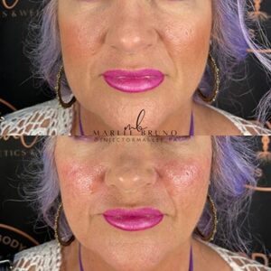Lip filler before and after result 01