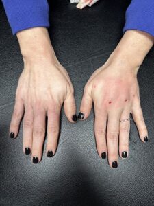 Hand radiasse before and after - 01