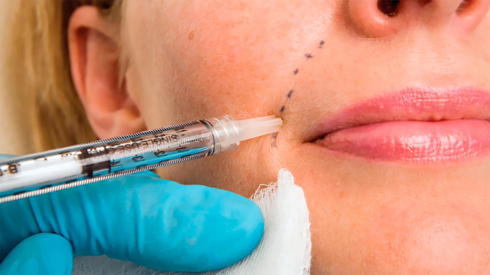 How Long Do Dermal Fillers Last? What to Expect Over Time - Mind Body & Soul Medical