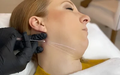 Exploring PDO Threads for a Non-Surgical Facelift