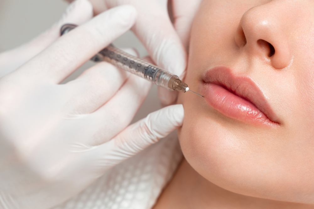 Eliminate Smoker’s Lines With Lip Filler Near Bellview, Florida