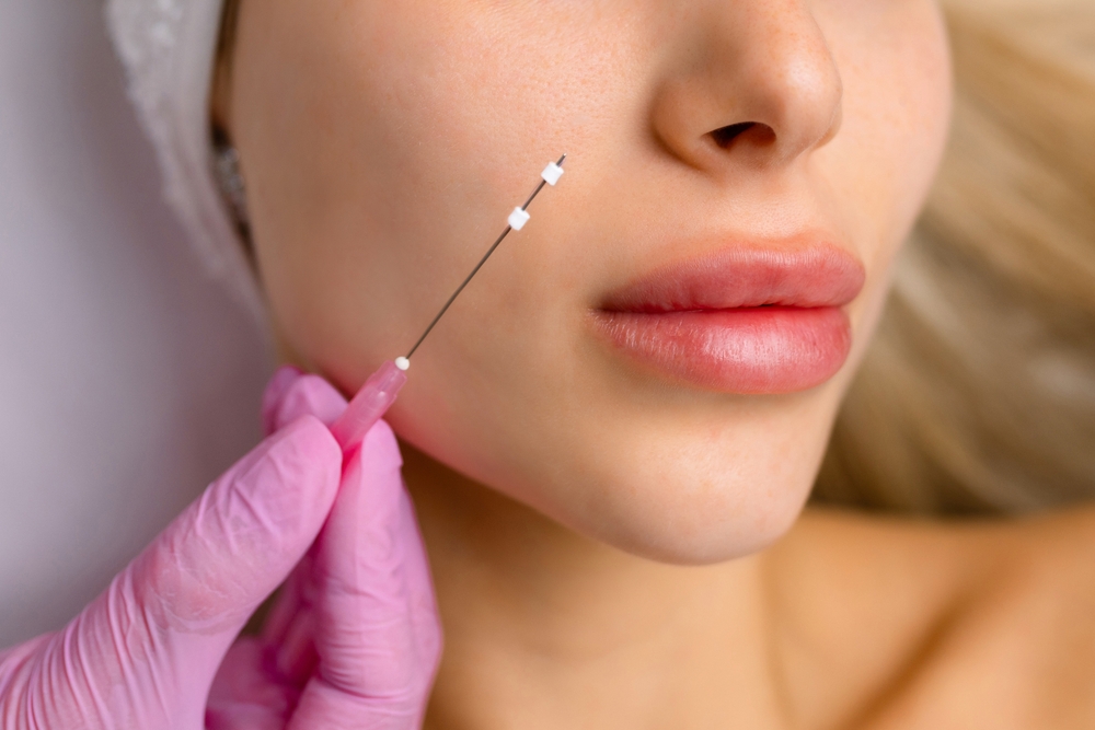 PDO Threads Near Gulf Shores, AL: A Recovery Guide After Your Instant Lift