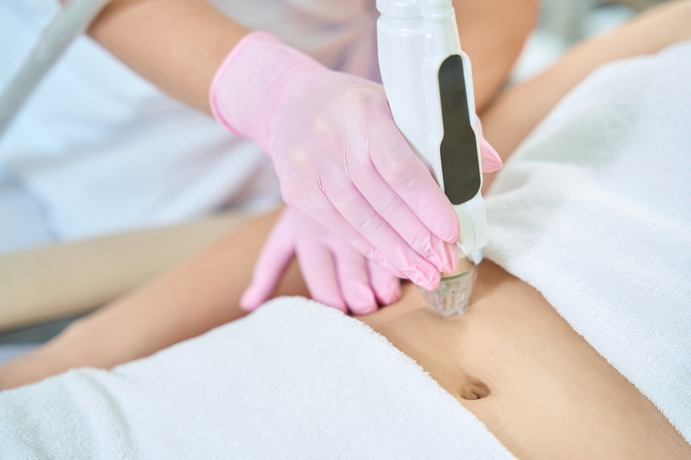 Can RF Microneedling Near Alabama Help Tighten Loose Skin Without Surgery?